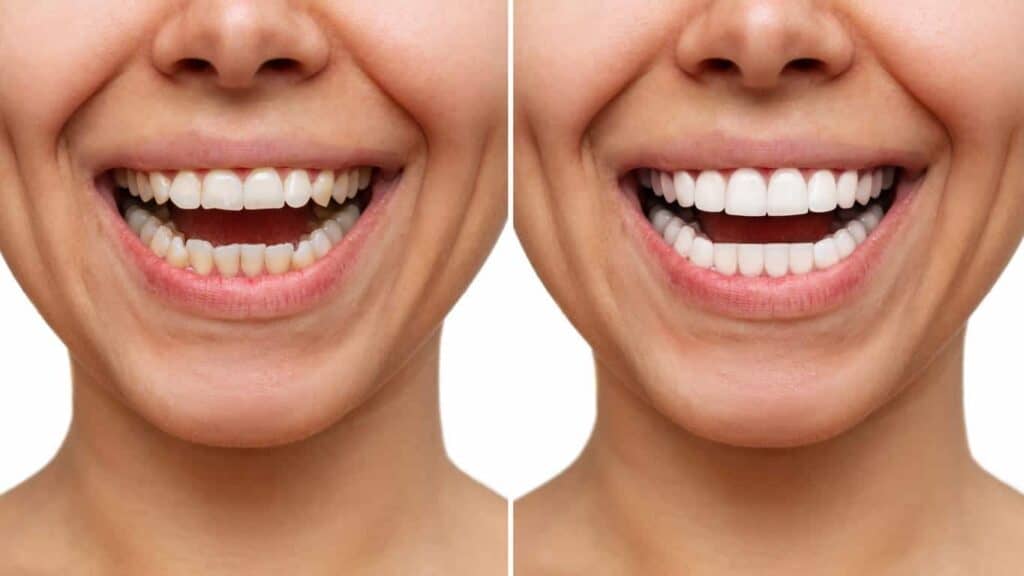 Before and after teeth whitening results. Warrington