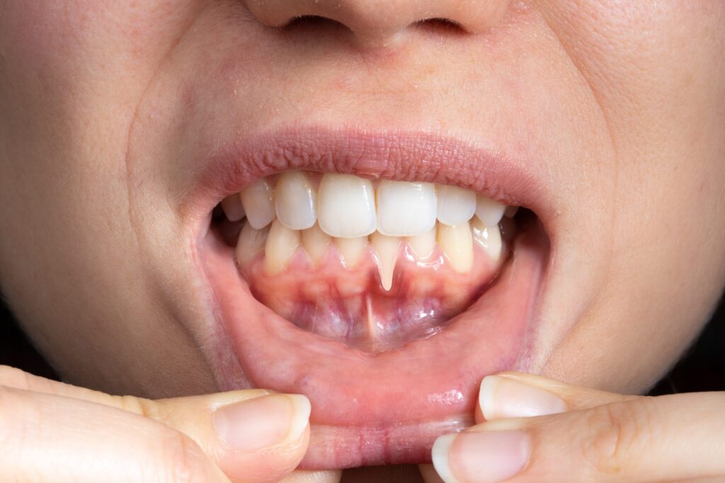 Preparing for teeth whitening with receding gums Warrington